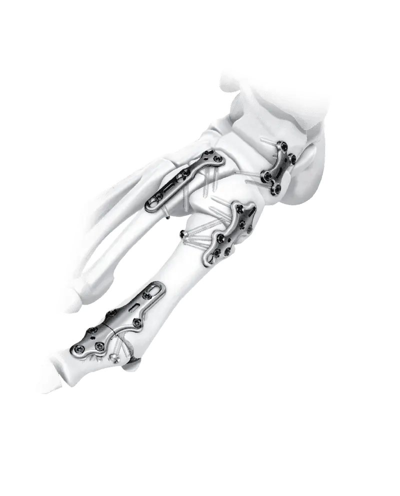 White and light-grey foot-and-ankle bone model with four metallic fixation plates mounted across the bones against a black background.
