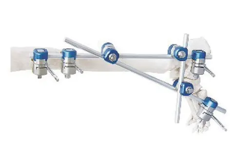 A-type ankle external fixator crossing the ankle onto the foot