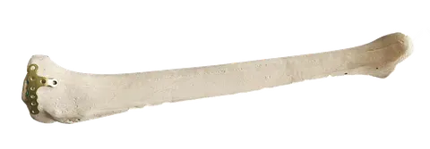 Anteromedial tibial plateau plate fixed onto a tibia bone model