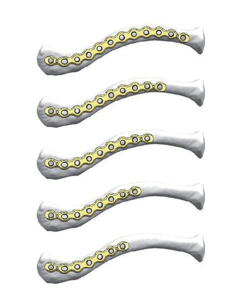 Five clavicle locking plates of graduated length shown seated along clavicle bones
