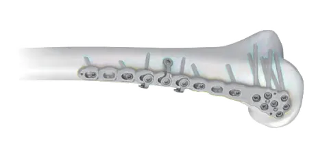 Locking connecting plates and screws assembled on a distal humerus