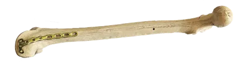 Distal medial femoral plate mounted along a femur specimen