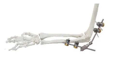 Elbow external fixator bridging humerus and forearm around the joint