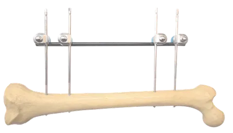 Femoral fixation plan on a bone model, four pins into the shaft under a single long rod