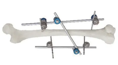 External fixator frame along a femur shaft model, pins entering above and below the shaft