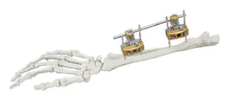 Forearm external fixator with pins in the radius and a rod running to the hand