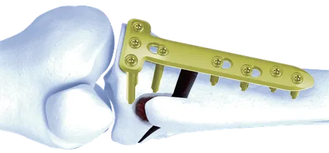 High tibial osteotomy plate fixed to the proximal tibia with the wedge held open