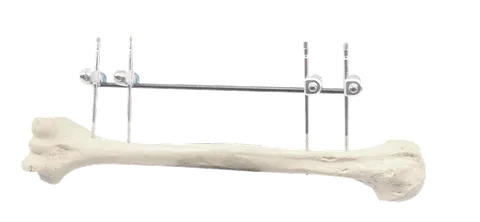 Humeral fixation plan on a bone model: four pin-to-rod clamps, four traction pins and one carbon fibre rod