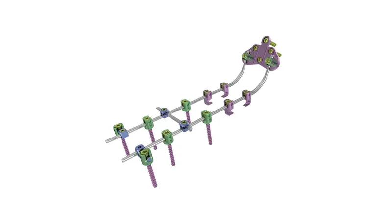 Rod-and-clamp implant assembly with two parallel silver-gray rods, green clamps, and purple threaded shafts on a white background.