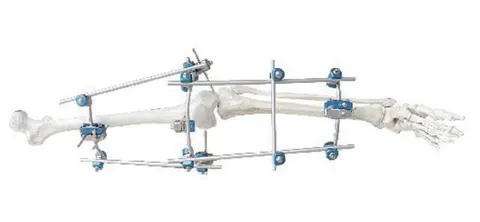 Knee-spanning external fixator bridging femur and tibia across the joint