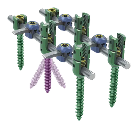 Posterior spinal construct: green threaded pedicle screws whose heads are clamped to two parallel grey rods by blue saddles and gold set screws, with four pink screws splayed beneath the rods