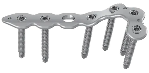 L reconstruction plate assembled with six locking screws in place