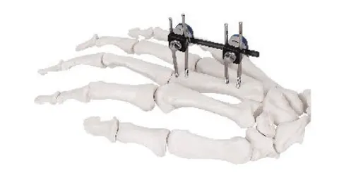 Mini fragment fixator on the hand skeleton, spanning finger and palm bones