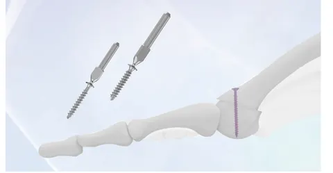 Two self-drilling self-tapping screws above a foot skeleton, one seated across the joint