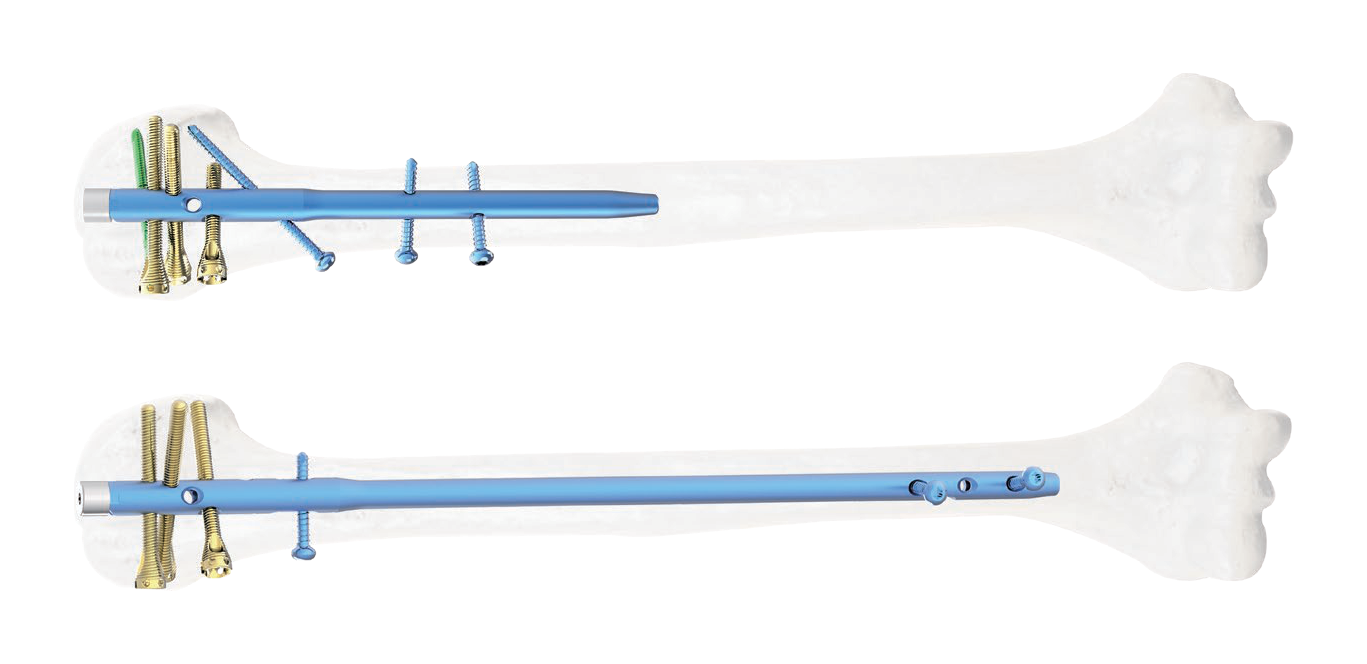 Two stacked horizontal views show blue cylindrical shafts over white bone-shaped silhouettes, with circular openings and transverse components against black