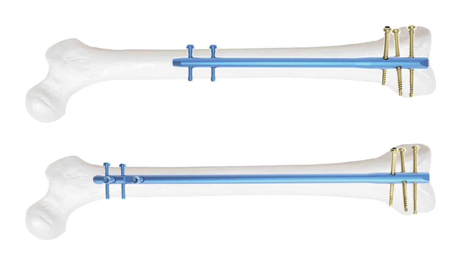 Two stacked views show white elongated bone forms with straight blue central nails, transverse blue elements, and gold threaded screws grouped at the right