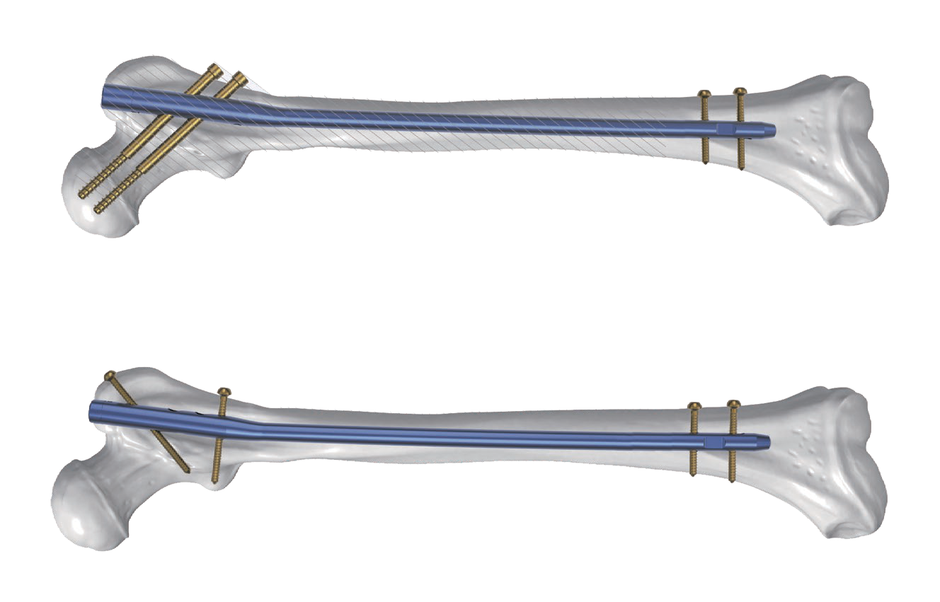 Two stacked views show white elongated bones with slightly curved blue rods and gold transverse screws positioned near their ends against a black field