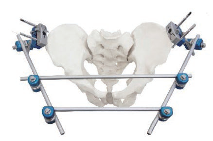 Pelvic external fixator with an anterior frame carried on pins in both iliac crests