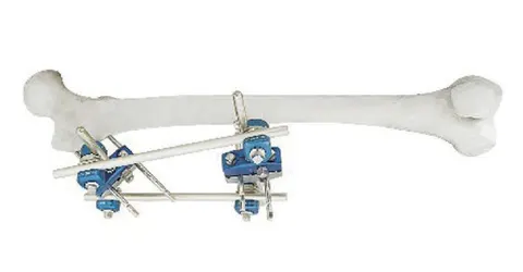 External fixator anchored in the proximal femur, with clamps stacked on a single rod