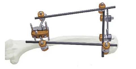 External fixator on the proximal humerus, clamps set on twin rods