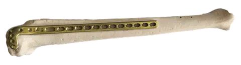 Proximal lateral tibial plate fitted along a tibia bone model