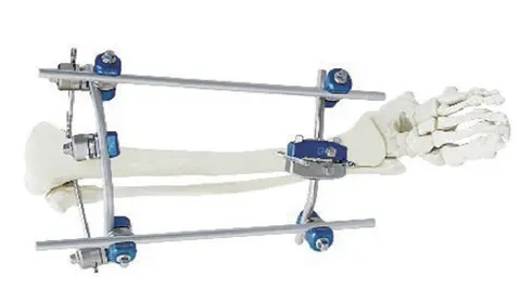External fixator frame spanning the proximal tibia on a bone model, with pin-to-rod clamps on two rods