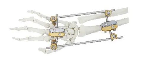 Wrist-spanning external fixator from the radius across to the metacarpals