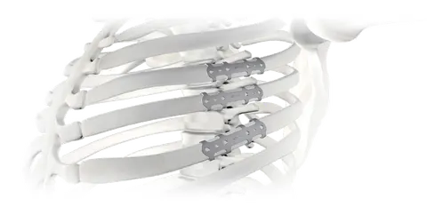 Three rib plates fixed across the ribs of a thoracic skeleton