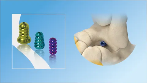 Three anodised subtalar screws in graduated sizes beside a hindfoot bone model with a screw seated across the sinus tarsi