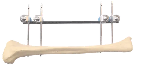 Tibial fixation plan on a bone model, with the rod carried clear of the shaft on four pins